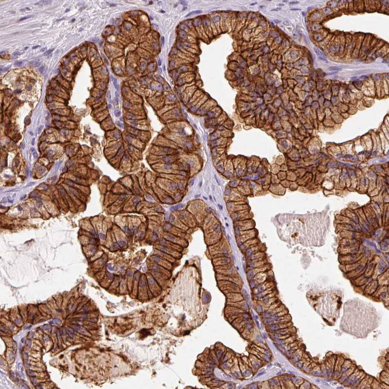 Staining of human prostate cancer shows strong membranous and cytoplasmic positivity in tumor cells.