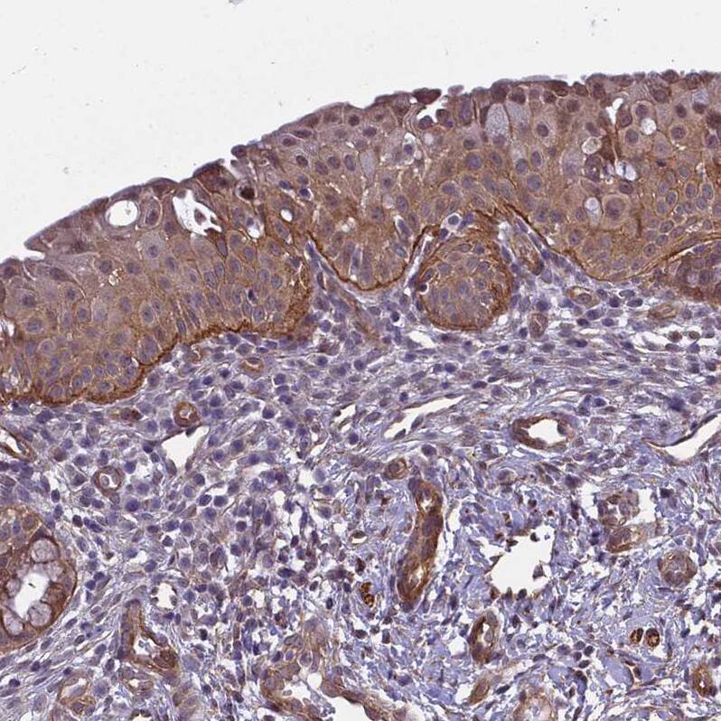 Staining of human cervix, uterine shows moderate to strong membranous positivity in squamous epithelial cells.