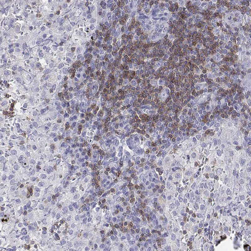 Staining of human lymph node shows weak to moderate cytoplasmic positivity in lymphoid cells.