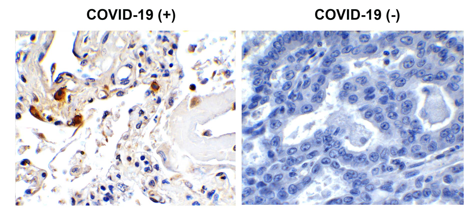 Immunohistochemistry: SARS-CoV-2 Envelope Antibody - BSA Free [NBP2-41061] - Figure 1 Immunohistochemistry Validation of SARS-CoV-2 (COVID-19) Envelope in COVID-19 Patient Lung Immunohistochemical analysis of paraffin-embedded COVID-19 patient lung tissue using anti- SARS-CoV-2 (COVID-19) Envelope antibody (, 1 u/mL). Tissue was fixed with formaldehyde and blocked with 10% serum for 1 h at RT; antigen retrieval was by heat mediation with a citrate buffer (pH6). Samples were incubated with primary antibody overnight at 4C. A goat anti-rabbit IgG H&L (HRP) at 1/250 was used as secondary. Counter stained with Hematoxylin. Strong signal of SARS-COV-2 envelope protein was observed in macrophage of COVID-19 patient lung, but not in non-COVID-19 patient lung.