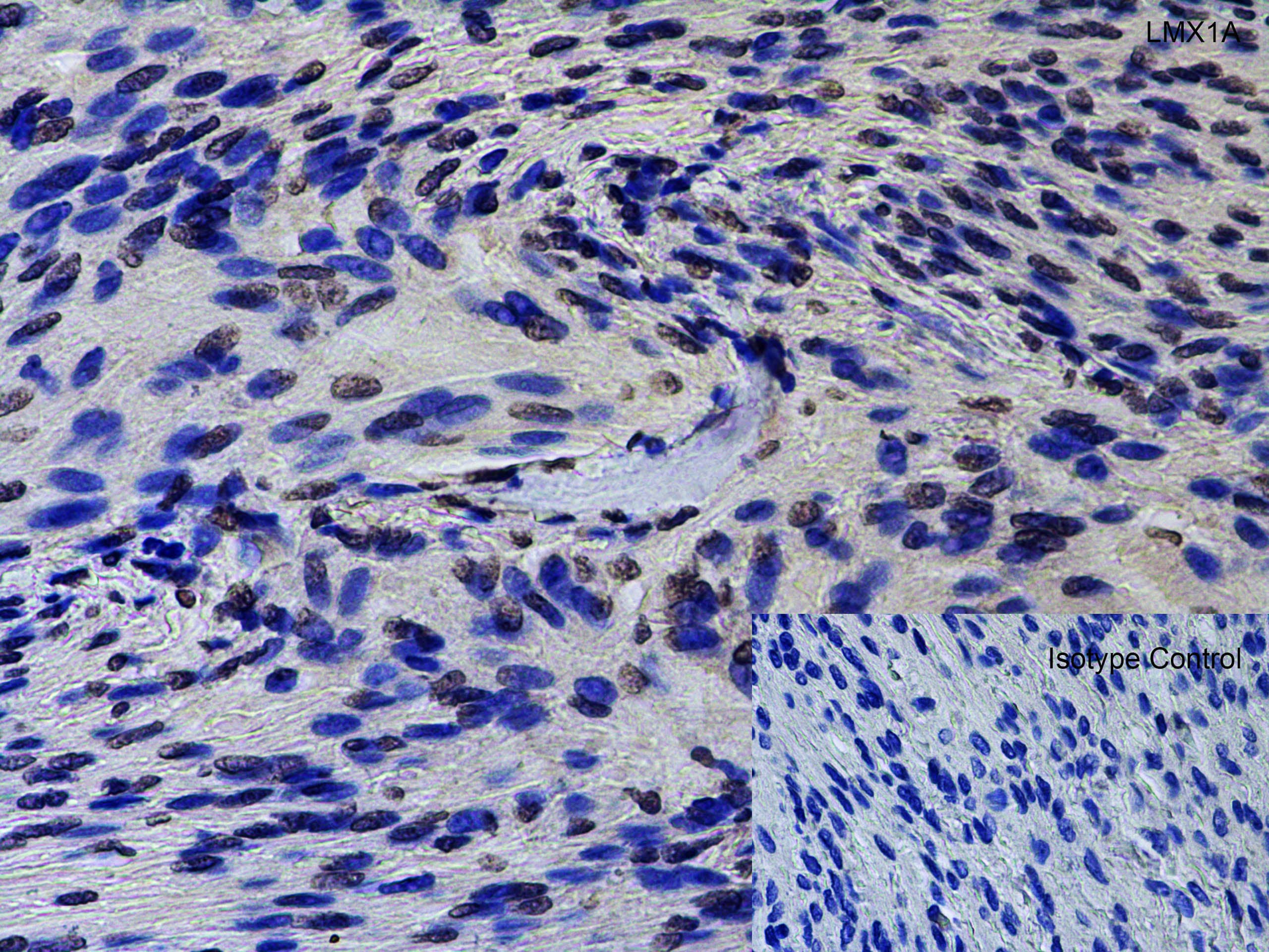 Immunohistochemistry: LMX1A Antibody - BSA Free [NBP2-41193] - Figure 5 Immunohistochemistry Validation of LMX1A in Human Brain Meningioma Immunohistochemical analysis of paraffin-embedded human brain meningioma using anti-LMX1A antibody  at 2 u/ml. Tissue was fixed with formaldehyde and blocked with 10% serum for 1 h at RT; antigen retrieval was by heat mediation with a citrate buffer (pH6). Samples were incubated with primary antibody overnight at 4#730;C. A goat anti-rabbit IgG H&L (HRP) at 1/250 was used as secondary. Counter stained with Hematoxylin.