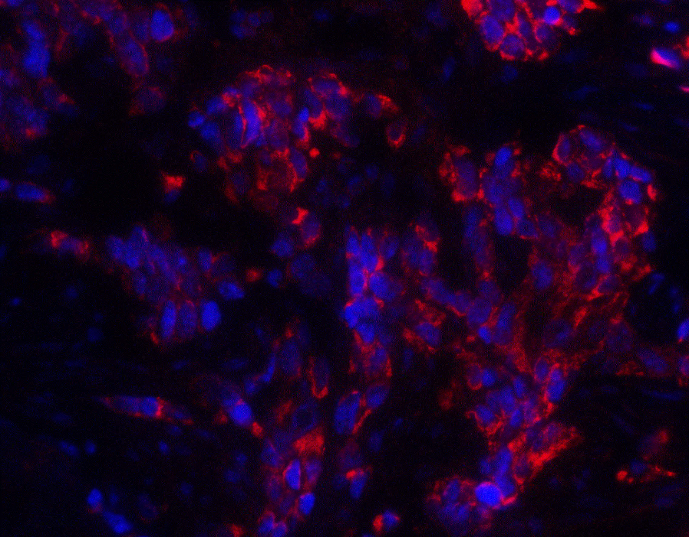 Immunocytochemistry/ Immunofluorescence: MAGEA4 Antibody - BSA Free [NBP2-41318] - Immunofluorescence of MAGEA4 in human breast cancer tissue with MAGEA4 antibody at 20 u/ml.Green: MAGEA4 Antibody   Blue: DAPI staining