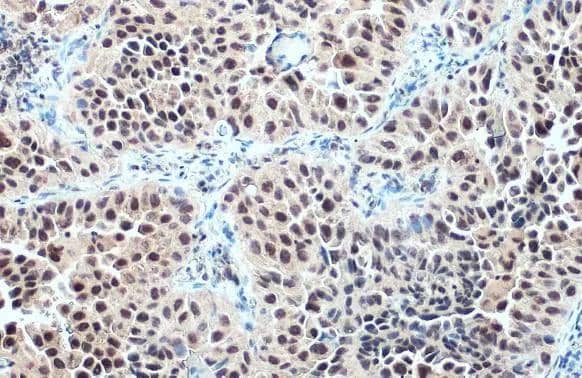 Glucocorticoid Receptor antibody detects Glucocorticoid Receptor protein at cytoplasm and nucleus by immunohistochemical analysis.Sample: Paraffin-embedded human lung cancer.Glucocorticoid Receptor stained by Glucocorticoid Receptor antibody (GT 