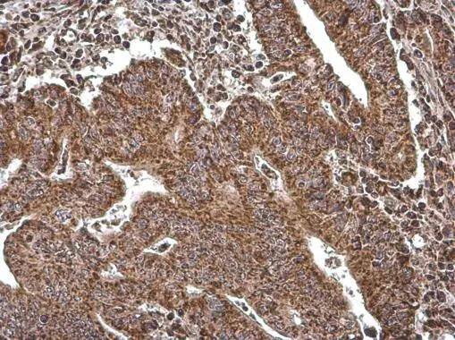 COX4 antibody [GT854] detects COX4 protein at mitochondria by immunohistochemical analysis.Sample: Paraffin-embedded human colon cancer.COX4 stained by COX4 antibody [GT854] (NBP2-43540) diluted at 1:200.Antigen Retrieval: Tris-EDTA buffer, pH 9.0, 15 min 