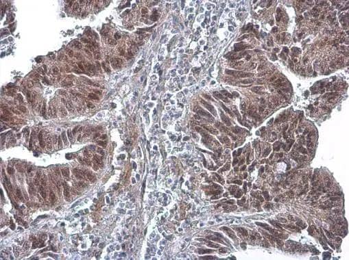 DNA polymerase delta antibody [6196] detects DNA polymerase delta protein at cytoplasm and nucleus by immunohistochemical analysis.Sample: Paraffin-embedded human colon cancer.DNA polymerase delta stained by DNA polymerase delta antibody [6196] (NBP2-43556) diluted at 1:200.Antigen Retrieval: Citrate buffer, pH 6.0, 15 min 