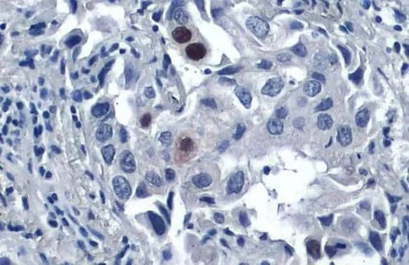 p21 Cip1 antibody [GT1032] detects p21 Cip1 protein at nucleus by immunohistochemical analysis.Sample: Paraffin-embedded human lung cancer.p21 Cip1 stained by p21 Cip1 antibody [GT1032] (NBP2-43697) diluted at 1:200.Antigen Retrieval: Citrate buffer, pH 6.0, 15 min 