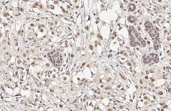 Immunohistochemistry-Paraffin: Nuf2 Antibody (312) [NBP2-43780] - Nuf2 antibody [GT312] detects Nuf2 protein at nucleus by immunohistochemical analysis.Sample: Paraffin-embedded human breast carcinoma.Nuf2 stained by Nuf2 antibody [GT312] (NBP2-43780) diluted at 1:500.Antigen Retrieval: Citrate buffer, pH 6.0, 15 min