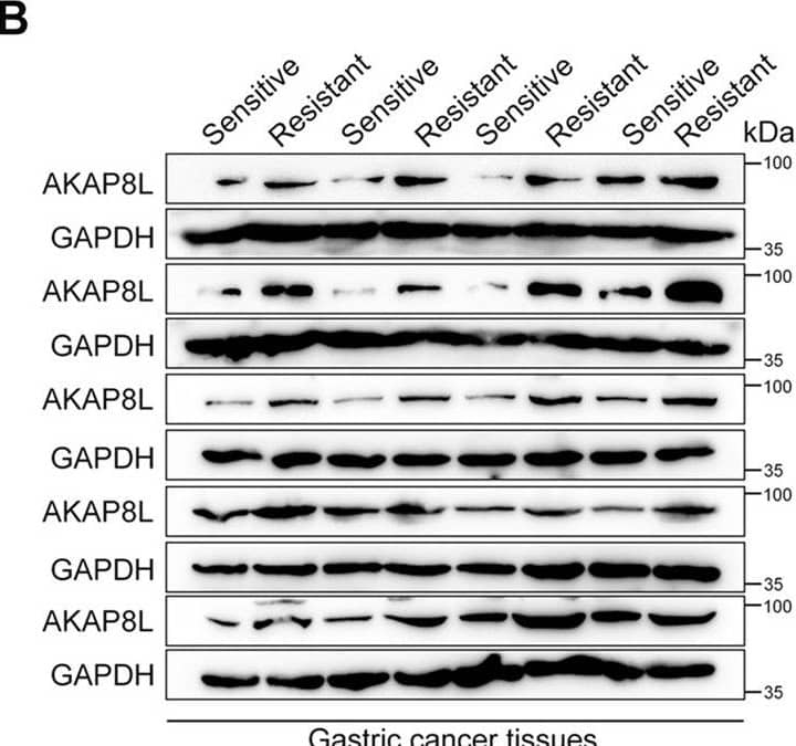 AKAP8L is upregulated in chemoresistant gastric cancer.A Diagram of the interactions of the top 20 upregulated genes in non-responders to chemotherapy versus responders in a cohort of 6 patients treated at Shandong Cancer Hospital and Institute. B Western blot analysis of AKAP8L in chemosensitive and chemoresistant gastric tumors. Representative images of AKAP8L and CD133 immunostaining in para-carcinoma tissues and gastric tumor tissues (C, D) (tissue array, n = 80). E Two-tailed Spearman’s correlation analysis of AKAP8L and CD133 expression in GC tissues. F, G Analysis of the AKAP8L and CD133 expression levels in relation to the overall survival of GC patients (tissue array, n = 80). H, I Analysis of the AKAP8L expression levels in relation to the overall survival (H) and first progression (I) of GC patients treated with chemotherapy regimen from the Kaplan–Meier plotter database (222160_at) (n = 875). Upper panel: scale bars: 500 μm. Lower panel: scale bars: 20 μm. Image collected and cropped by CiteAb from the following open publication (//pubmed.ncbi.nlm.nih.gov/36522343), licensed under a CC-BY license. Not internally tested by Novus Biologicals.