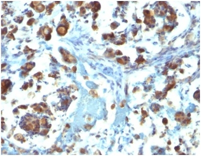 Formalin-fixed, paraffin-embedded human gastric carcinoma stained with MUC3 antibody (M3.1).1). HIER: Tris/EDTA, pH9.0, 45min. Secondary: HRP-polymer, 30min. DAB, 5min.