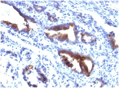 Formalin-fixed, paraffin-embedded human gastric carcinoma stained with MUC3 antibody (M3.1).1). HIER: Tris/EDTA, pH9.0, 45min. Secondary: HRP-polymer, 30min. DAB, 5min.