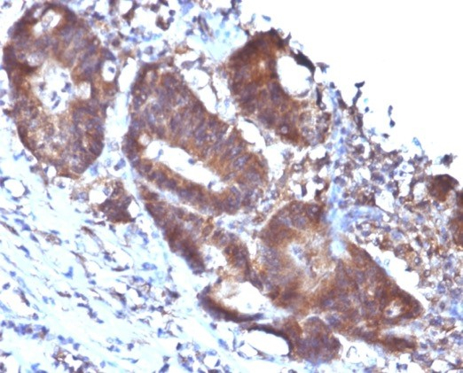 Formalin-fixed, paraffin-embedded human colon carcinoma stained with Transgelin/TAGLN/SM22 alpha antibody (TAGLN/247).