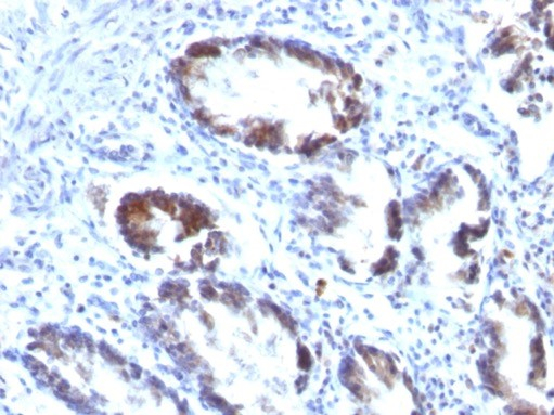 Formalin-fixed, paraffin-embedded human colon carcinoma stained with Transgelin/TAGLN/SM22 alpha antibody (TAGLN/247). HIER: Tris/EDTA, pH9.0, 45min. Secondary: HRP-polymer, 30min. DAB, 5min.