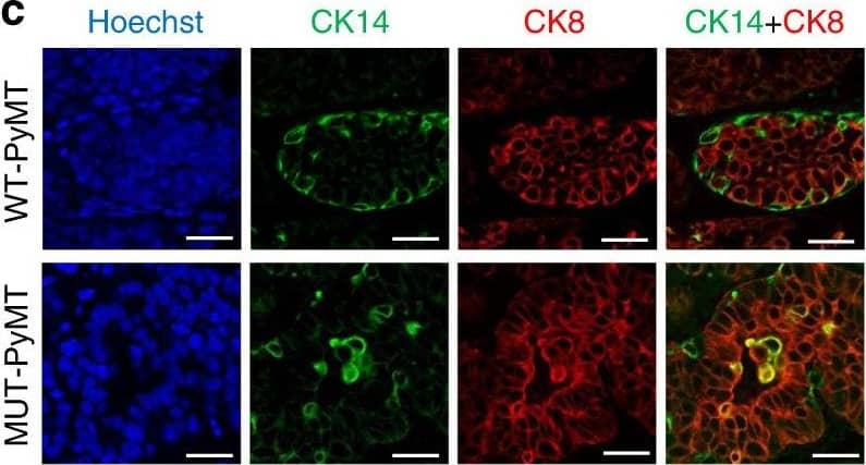 Loss of TET2 expression promotes tumorigenesis and tamoxifen resistance in vivo. c Representative immunofluorescence images showing co-staining of CK8 (red) and CK14 (green) in mammary glands of 7-week-old WT-PyMT and MUT-PyMT female mice (scale bar: 50 um), and d bar graphs showing percentage of CK14+CK8-, CK14-CK8+, and CK14+CK8+cells. n = 8 data points analyzed from eight independent tissue section staining images of two animals for each group. Data were presented as mean +/- SD. p-values were determined by two-sided Student's t-test between the indicated two groups; asterisk indicates p < 0.05. Image collected and cropped by CiteAb from the following publication (//pubmed.ncbi.nlm.nih.gov/32934200), licensed under a CC-BY licence.