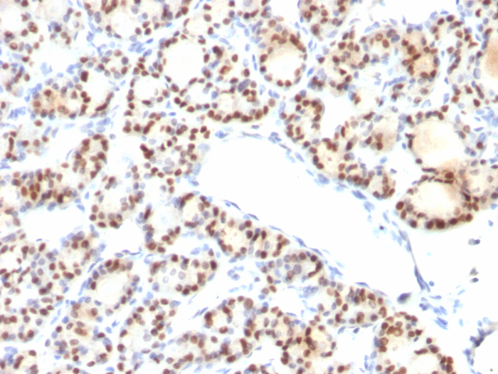 Formalin-fixed, paraffin-embedded human thyroid stained with TTF-1 / NKX2-1 antibody (NX2.1/690).1/690). HIER: Tris/EDTA, pH9.0, 45min. Secondary: HRP-polymer, 30min. DAB, 5min.