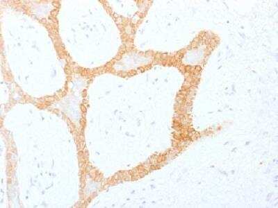Immunohistochemistry-Paraffin: Cytokeratin 5/8 Antibody (C-50) - Azide and BSA Free [NBP2-47824] - Formalin-fixed. paraffin-embedded human colon carcinoma stained with cytokeratin 5/8 Monoclonal Antibody (C-50)
