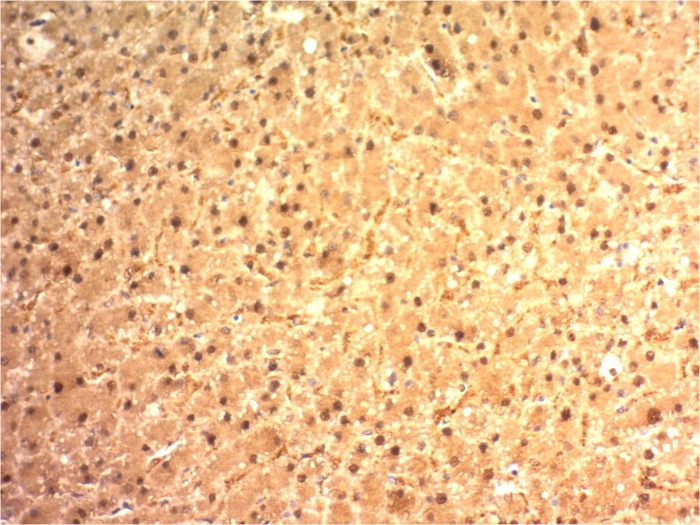 Formalin-fixed, paraffin-embedded human Hepatocellular Carcinoma stained with Arginase 1/ARG1/liver Arginase antibody (ARG1/1125).