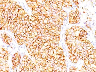 Immunohistochemistry-Paraffin: Carbonic Anhydrase IX/CA9 Antibody (66.4.C2 (PN-15)) - IHC-Prediluted [NBP2-48405] - FFPE human renal cell carcinoma stained with RCC Ab (66.4.C2).  Note cytoplasmic & cell surface staining of tumor cells.