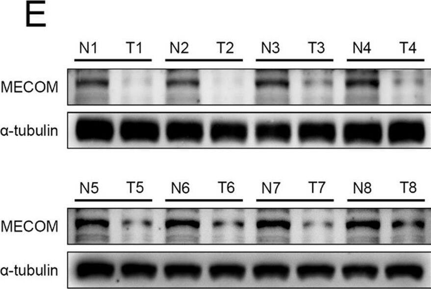 Validation of MECOM expression levels in clinical KIRC samples. A Relative MECOM mRNA levels in tumor and adjacent normal tissues of 24 patients with KIRC. B MECOM mRNA differential expression in 24 patients with KIRC between tumor and adjacent normal tissues. C Representative images of MECOM IHC staining in tumor and adjacent normal tissues in patients with various T stages (n = 147). D IHC scores of MECOM expression in tumor tissues of patients with KIRC at various clinical stages. E MECOM protein levels in tumor and adjacent normal tissues of eight patients of KIRC Image collected and cropped by CiteAb from the following open publication (//pubmed.ncbi.nlm.nih.gov/39576394), licensed under a CC-BY license. Not internally tested by Novus Biologicals.