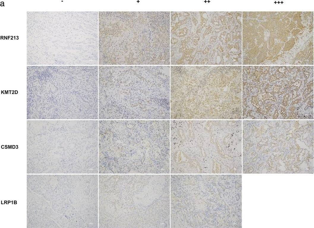 The results of immunohistochemistry. (a) Representative illustrations of the expression of RNF213, KMT2D, CSMD3 and LRP1B in lung cancer and benign disease. “−