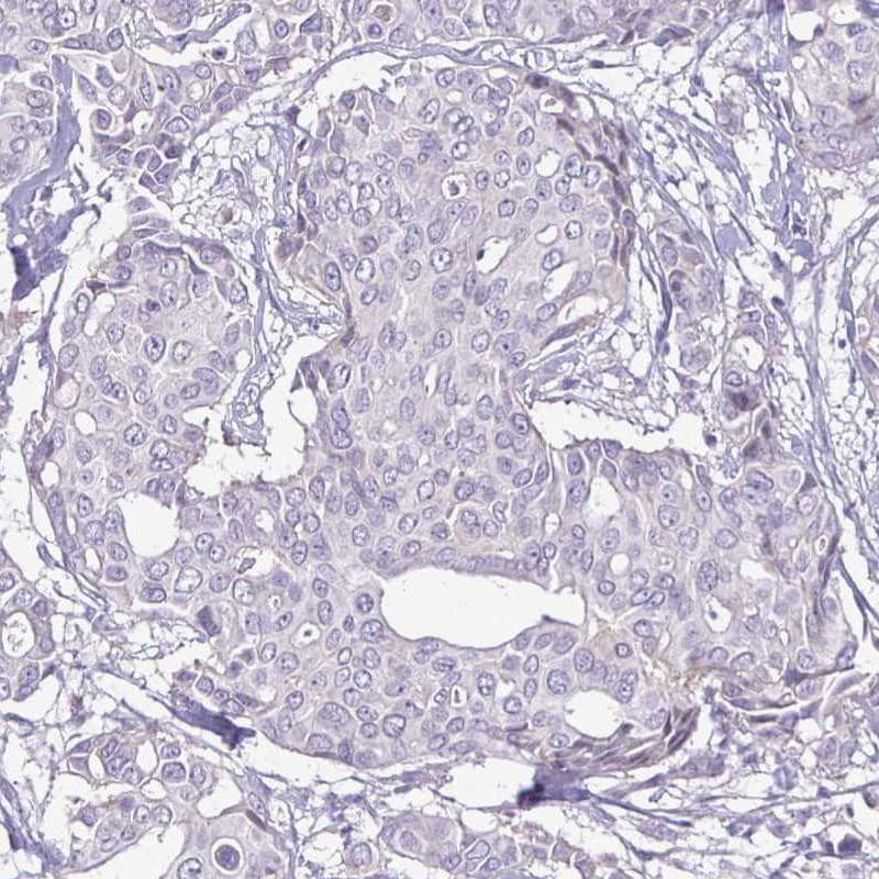 Staining of human HER2-negative breast cancer shows no positivity in tumor cells, as expected.