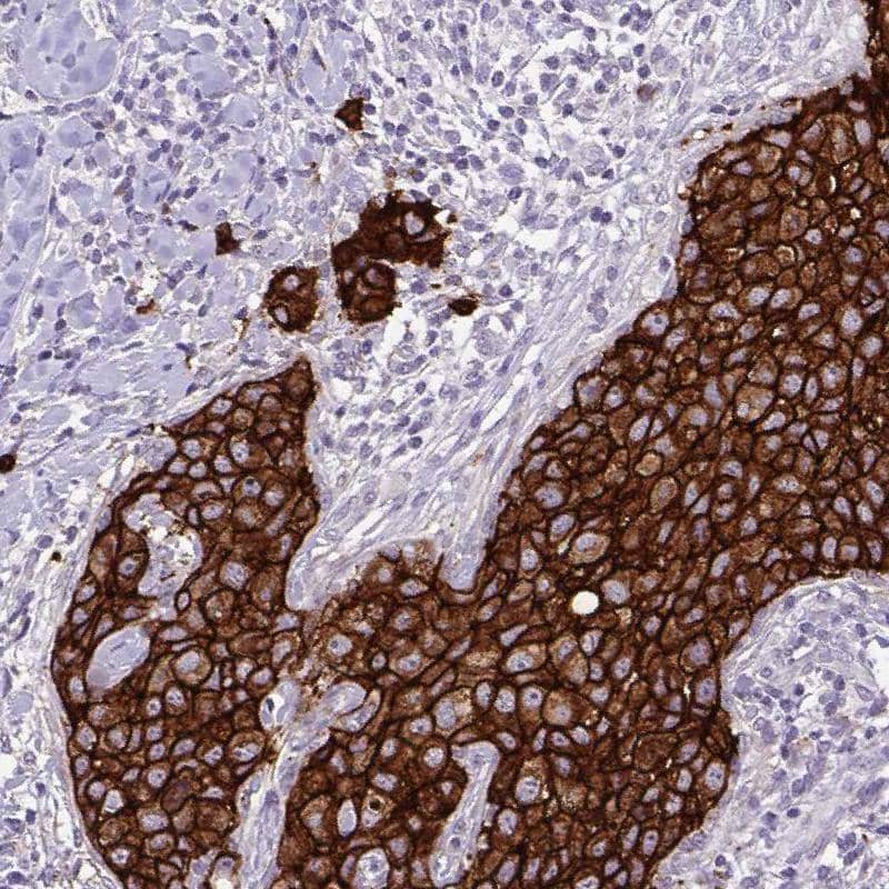Staining of human HER2-positive breast cancer shows strong membranous positivity in tumor cells.