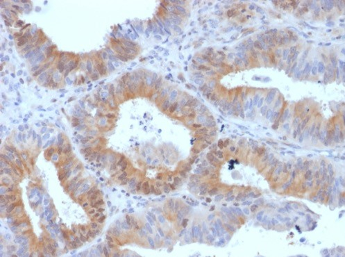 Formalin-fixed, paraffin-embedded human ovarian carcinoma stained with LHR antibody (LHCGR/1417).