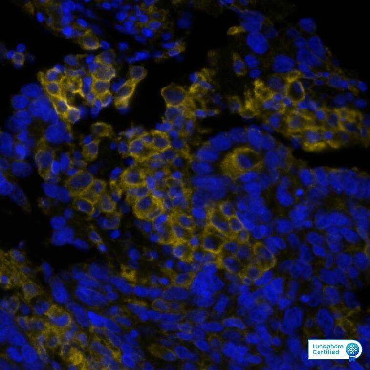PD-L1 was detected in immersion fixed paraffin-embedded sections of human Lung Tumor using Rabbit Anti-Human PD-L1, Monoclonal Antibody at 5ug/mL at 37°Celsius for 4 minutes. Before incubation with the primary antibody, tissue underwent an all-in-one dewaxing and antigen retrieval preprocessing using PreTreatment Module (PT Module) and Dewax and HIER Buffer H (pH 9; Epredia Catalog # TA-999-DHBH). Tissue was stained using the Alexa Fluor™ Plus 647 Goat anti-Rabbit IgG Secondary Antibody at 1:200 at 37°Celsius for 2 minutes. (Yellow; Lunaphore Catalog # DR647RB) and counterstained with DAPI (blue; Lunaphore Catalog # DR100). Specific staining was localized to the membrane. Protocol available in COMET™ Panel Builder.