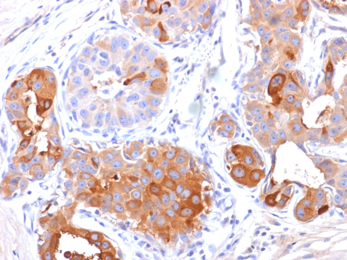 Formalin-fixed, paraffin-embedded human breast carcinoma stained with PIP antibody (PIP/1571). HIER: Tris/EDTA, pH9.0, 45min. Secondary: HRP-polymer, 30min. DAB, 5min.
