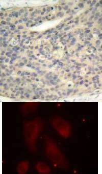 Immunohistochemistry: LIM Kinase 1/2 [p Thr508] Antibody - BSA Free [NBP2-54645] - Top Image: Immunohistochemical analysis of paraffin-embedded human breast carcinoma tissue using LIM Kinase 1/2 (Phospho-Thr508).Bottom Image: Immunofluorescence staining of methanol-fixed HeLa cells using LIM Kinase 1/2 (Phospho-Thr508).