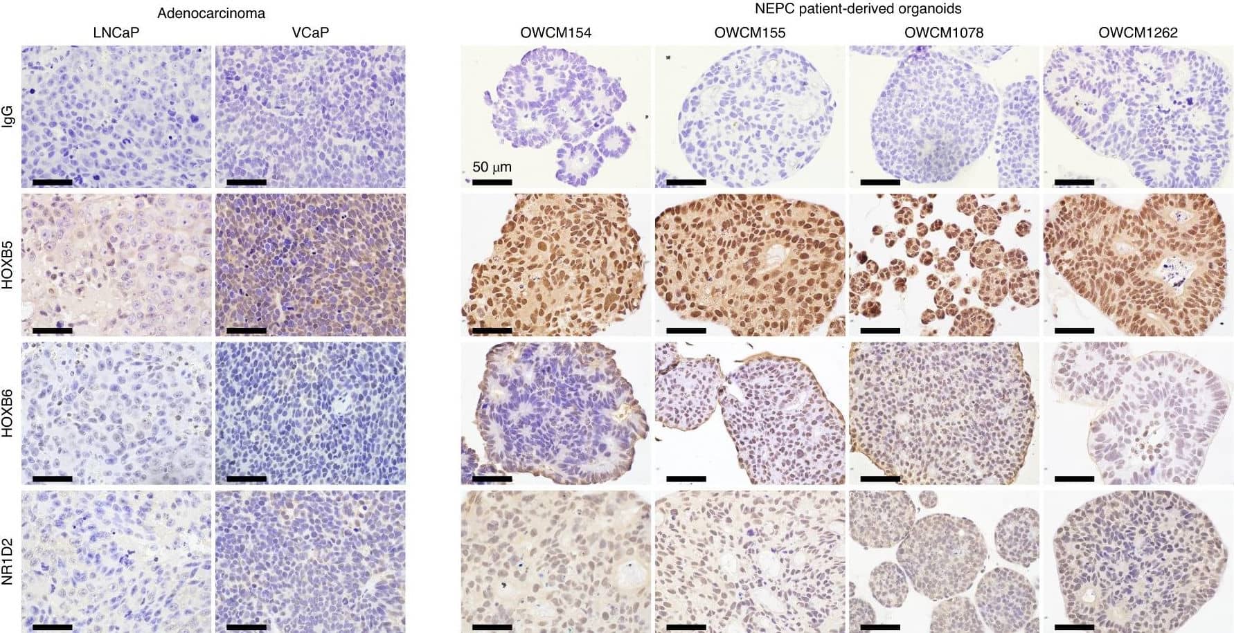 Immunohistochemistry: Rev-erb beta/NR1D2 Antibody [NBP2-56141] - Cancer cells from small cell carcinoma employ highly divergent regulatory program compared to adenocarcinoma cells.a,b, Gene set expression scores of single G1 cells using expression signature of NEPC18 (a) & set of genes regulated by AR17 (b). Box plots: center line, median; box limits, upper & lower quartiles; whiskers extend at most 1.5× interquartile range past upper & lower quartiles; P values from 2-sided Mann–Whitney U-test. c, Inferred activity of regulons of different transcriptional regulators. x axis, q values from comparison of inferred regulon activity in cancer cells from small cell carcinoma (n = 76) vs cancer cells from adenocarcinomas (n = 188, sampled as described in Methods) (negative values indicate regulon is less active in small cell carcinoma; two-sided Mann–Whitney U-test, median outcome of sampling iterations (Methods) w/ Bonferroni FWER correction). y axis: P values (two-sided Mann–Whitney U-test, signed as previous) from comparison of expression scores of scRNA-derived regulons in bulk RNA-seq of small cell carcinomas (n = 8) vs adenocarcinomas (n = 18) from a published cohort8. d, Regulon activity in single cells for select transcriptional regulators. e, Hierarchical clustering of bulk RNA-seq of a published cohort of prostate cancers of known histopathology18 based on expression of HOXB5, HOXB6 & NR1D2 regulons inferred from scRNA-seq. B–E correspond to different NEPC subtype labels from original publication. Expression levels of EZH2, NANOG & SOX2 shown for reference but not used in clustering (n = 34 adenocarcinoma, 15 NEPC). f, IHC staining of HOXB5, HOXB6 & NR1D2 protein levels in two prostate adenocarcinoma xenografts (LNCaP & VCaP) & four NEPC patient-derived organoids. Scale bar: 50 μm. Image collected & cropped by CiteAb from following publication (//pubmed.ncbi.nlm.nih.gov/33664492), licensed under a CC-BY license. Not internally tested by Novus Biologicals.