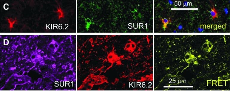 Immunocytochemistry/ Immunofluorescence: SUR1 Antibody (S289-16) [NBP2-59320] - Glial fibrillary acidic protein (GFAP)–positive specimens from human contusion- traumatic brain injury (TBI) exhibit KIR6.2 expression in astrocytes. (A) Immunolabeling for KIR6.2 showed sparse immunoreactivity in the control specimen (CTR) vs. widespread expression in a GFAP-positive specimen from contusion-TBI. (B) Double immunolabeling for GFAP (red) & KIR6.2 (green) showed astrocyte expression of KIR6.2; merged images confirm co-localization (yellow); in situ hybridization of the same tissue section for Kcnj11 messenger RNA showed positive signal co-localized with GFAP-positive, KIR6.2-expressing astrocytes; arrowheads point to cells with all three signals. (C) Double immunolabeling showed that KIR6.2 (red) & sulfonylurea receptor 1 (SUR1; green) were co-localized (yellow) in astrocytes. (D) ImmunoFRET for SUR1 (magenta) & KIR6.2 (red) showed co-assembly of SUR1-KIR6.2 heteromers (yellow pseudocolor) in astrocytes. (E) Double immunolabeling showed that KIR6.2 (green) & transient receptor potential cation channel subfamily M member 4 (TRPM4) (red) were co-localized in astrocytes. The findings illustrated are representative of all GFAP-positive specimens from eight cases of human contusion-TBI. (case #2, 11 days post-TBI; case #5, 1 day post-TBI) Image collected & cropped by CiteAb from the following publication (//pubmed.ncbi.nlm.nih.gov/30160201), licensed under a CC-BY license. Not internally tested by Novus Biologicals.