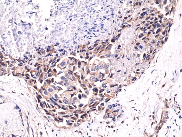 Immunohistochemistry-Paraffin: AKT1 [p Ser473] Antibody (RM251) [NBP2-61475] - IHC-P staining of FFPE human breast cancer tissue sections using NBP2-61475 at a 1:400 dilution.