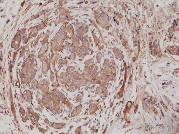 Immunohistochemistry-Paraffin: Alpha Actinin 4 Antibody (RM287) [NBP2-61485] - Immunohistochemical staining of formalin fixed and paraffin embedded human breast cancer tissue sections using NBP2-61485 at a 1:200 dilution