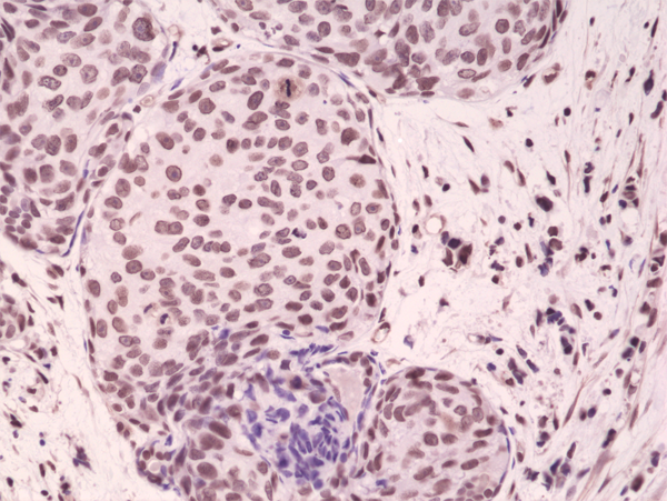 Immunohistochemistry-Paraffin: p38 alpha [p Tyr182, p Thr180] Antibody (RM243) [NBP2-61574] - Immunohistochemical staining of formalin fixed and paraffin embedded human breast cancer tissue sections using NBP2-61574.