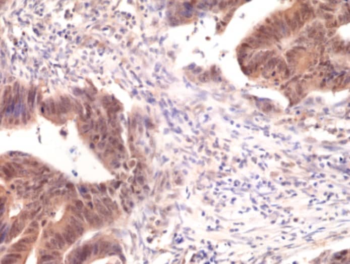 Immunohistochemistry-Paraffin: Smad4 Antibody (RM277) [NBP2-61587] - Immunohistochemical staining of formalin fixed and paraffin embedded human colon cancer tissue sections using NBP2-61587 at a 1:5000 dilution.