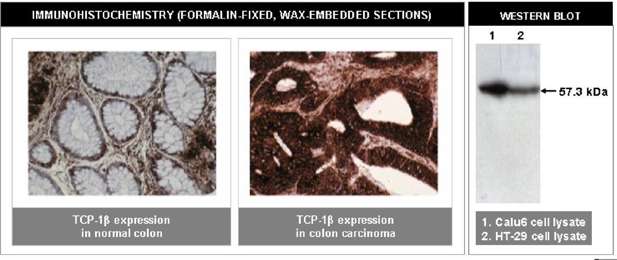 Immunohistochemistry: TCP1-beta Antibody (F39 P7 F11) [NBP2-66591] -  Left and Center: Immunohistochemical staining of normal (left) and cancerous (center) colon tissue using TCP-1 beta  antibody (Cat. No. NBP2-66591).Right: Western blot analysis using TCP-1 beta  antibody on Calu6 (1) and HT-29 (2) cell lysates.