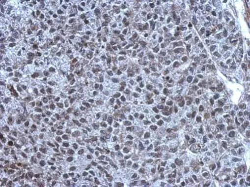 Immunohistochemistry: TET1 Antibody [NBP2-76345] - Immunohistochemical analysis of paraffin-embedded Hela xenograft, using TET1 (NBP2-76345) antibody at 1:1000 dilution.Antigen Retrieval: Trilogy™ (EDTA based, pH 8.0) buffer, 15min