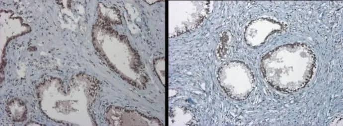 Immunohistochemistry: TET1 Antibody [NBP2-76345] - TET1 antibody [N3C1] detects TET1 protein at nucleus on Human normal prostate tissue by immunohistochemical analysis. Sample: Paraffin-embedded Human normal prostate tissue. TET1 antibody [N3C1] (NBP2-76345) dilution: 1:1000.Antigen Retrieval: Trilogy™ (EDTA based, pH 8.0) buffer, 15min