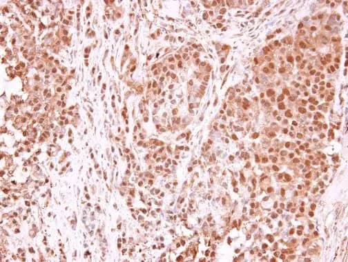 Immunohistochemistry-Paraffin: TET1 Antibody [NBP2-76345] - TET1 antibody [N3C1] detects TET1 protein at nucleus in human A549 xenograft by immunohistochemical analysis. Sample: Paraffin-embedded human A549 xenograft . TET1 antibody [N3C1] (NBP2-76345) diluted at 1:250.Antigen Retrieval: Trilogy™ (EDTA based, pH 8.0) buffer, 15min