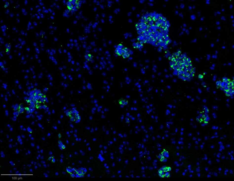 Immunohistochemistry-Frozen: Mouse Monoclonal Cytokeratin, pan Antibody (PAN-CK (Cocktail)) [Alexa Fluor® 488] [NBP2-76425AF488] - MDA-MB-231 tumor cells (human breast tumor cell line) have been injected intracranially in immunodeficient mouse pups to form tumor. Sections have been stained with Pan-CK-A488 (green) (Catalog # NBP2-76425AF488) and Hoechst (blue). Image from a verified customer review.