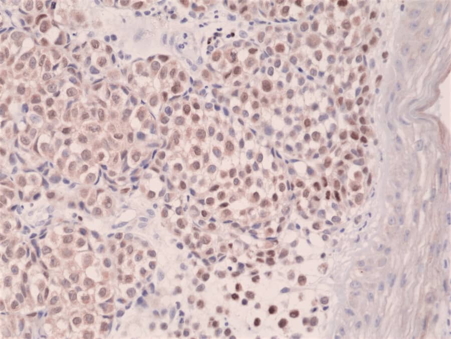 Immunohistochemistry: IRF4 Antibody (RM352) [NBP2-77422] - Immunohistochemical staining of formalin fixed and paraffin embedded human melanoma tissue section using NBP2-77422.