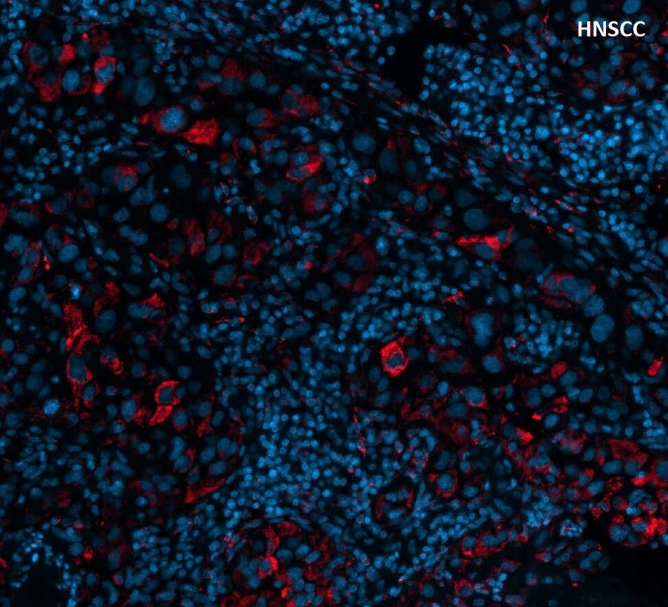 Immunohistochemistry-Paraffin: TIM-3 Antibody (TIM3/3113) [NBP2-79702] - TIM-3 was stained in human FFPE head and neck squamous cell carcinoma tissue. HIER antigen retrieval for 20min at pH 9. AF750 conjugated version of antibody was used (Catalog # NBP2-79836AF750). Image from a verified customer review.