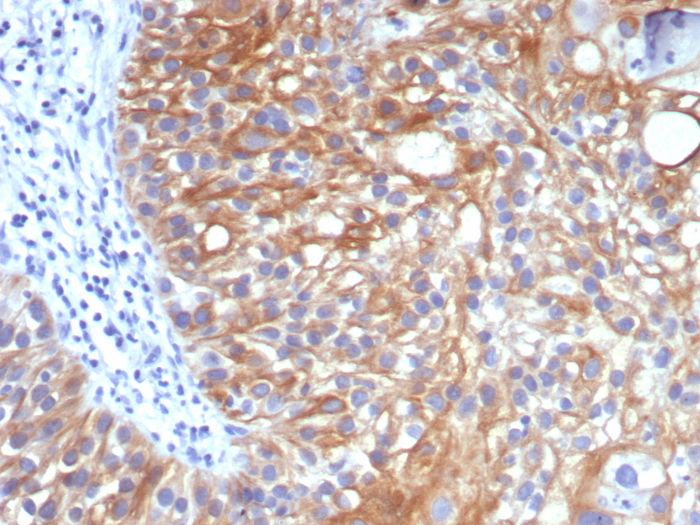 Formalin-fixed, paraffin-embedded human bladder carcinoma stained with TIM-3 antibody (TIM3/3113). HIER: Tris/EDTA, pH9.0, 45min. Secondary: HRP-polymer, 30min. DAB, 5min.