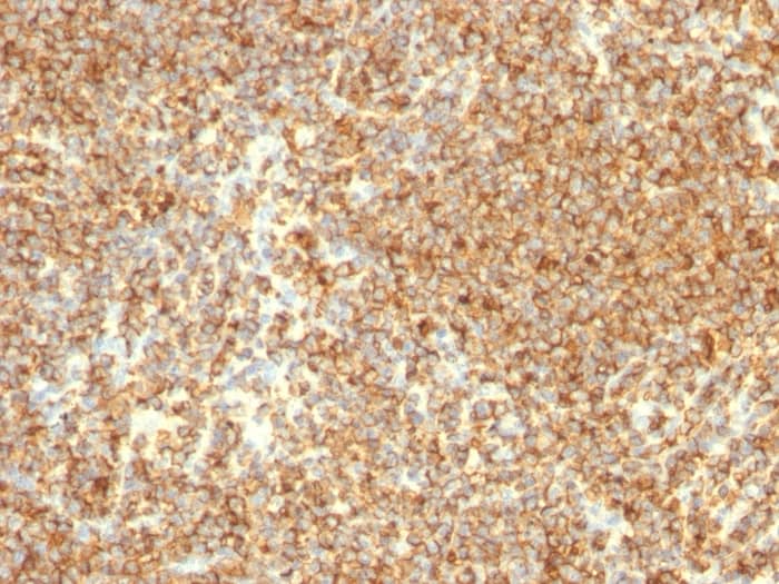 Formalin-fixed, paraffin-embedded human Lymphoma stained with CD20 Antibody (L26).