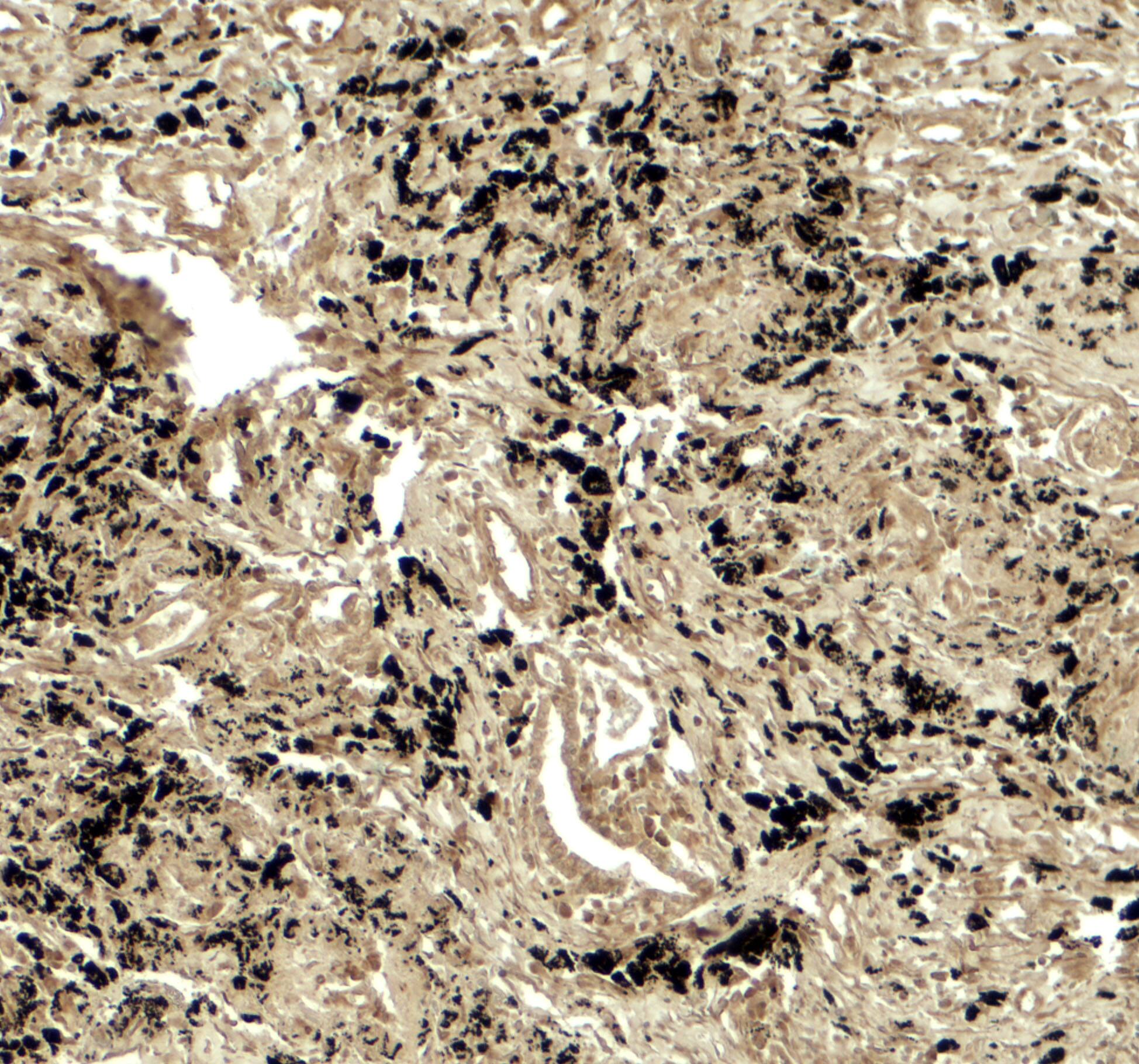 Immunohistochemistry: PPM1D Antibody - BSA Free [NBP2-81881] - Immunohistochemistry of PPM1D in human lung carcinoma tissue with PPM1D antibody at 5 ug/ml.