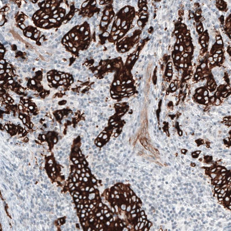 Staining of human breast cancer shows strong cytoplasmic positivity in tumor cells.