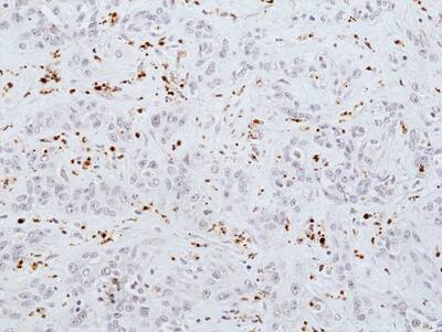 Immunohistochemistry-Paraffin: Myeloperoxidase/MPO Antibody (RM407) [NBP2-89098] - Immunohistochemical staining of formalin fixed and paraffin embedded human cholangiocarcinoma tissue section using NBP2-89098 at 1:100 dilution.