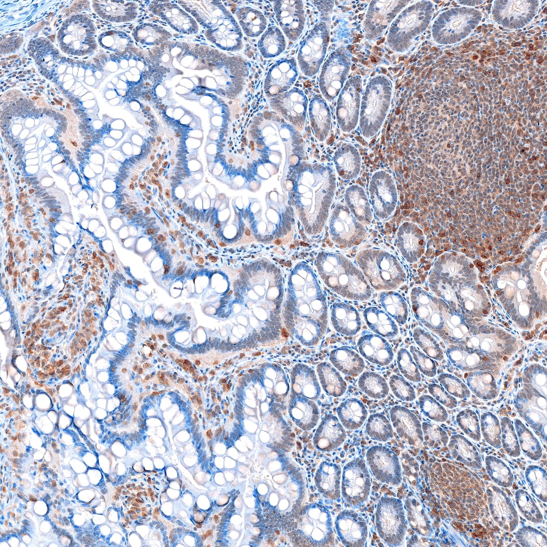 Immunohistochemistry: Rabbit Monoclonal CD8 beta Antibody (039) [NBP2-89751] - CD-8 beta staining of Rhesus macaque colon tissue. 1:1000 ON @ 4°C after citraconic anhydride (CA)/pressure cooker antigen retrieval, P1 Rb with DAB detection. Image from a verified customer review.