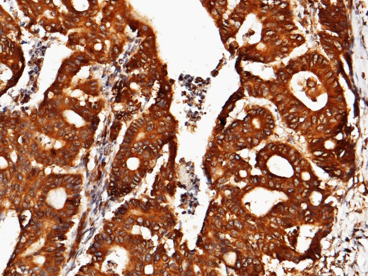 Immunohistochemistry-Paraffin: ORP150/HSP12A Antibody (201) [NBP2-89890] - Staining of human ORP150/HSP12A in human colon carcinoma with NBP2-89890 (1:200).