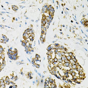 Immunohistochemistry: Adenylosuccinate Synthase Antibody - BSA Free [NBP2-92661] - Immunohistochemistry analysis of paraffin-embedded Human esophageal cancer using Adenylosuccinate Synthase Rabbit pAb  at dilution of 1:100 (40x lens). Microwave antigen retrieval performed with 0.01M PBS Buffer (pH 7.2) prior to IHC staining.